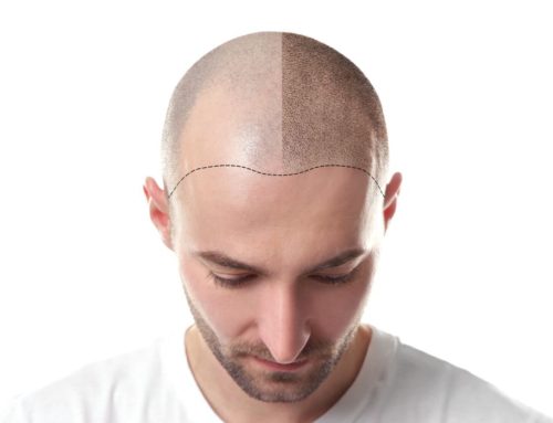 Scalp Pigmentierung